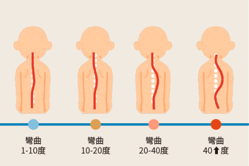 脊椎側彎