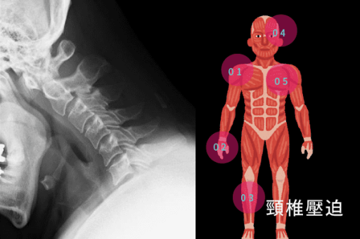 頸椎壓迫