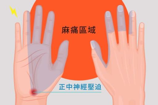 腕隧道症候群