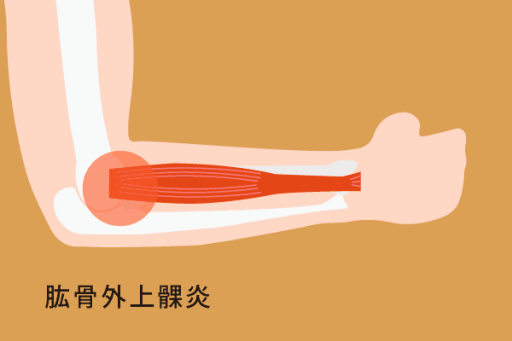 網球肘