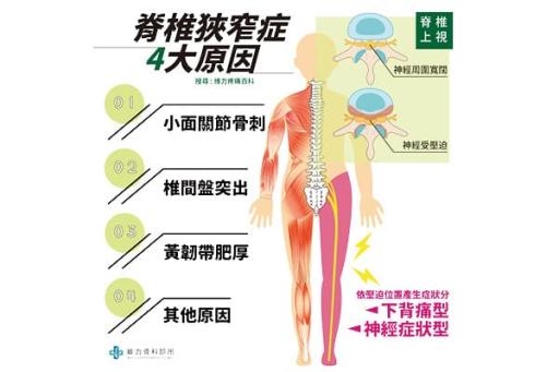脊椎狹窄症