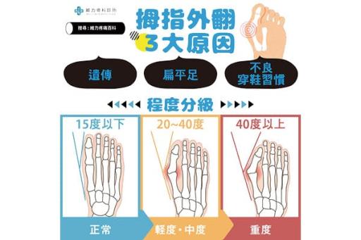 拇指外翻