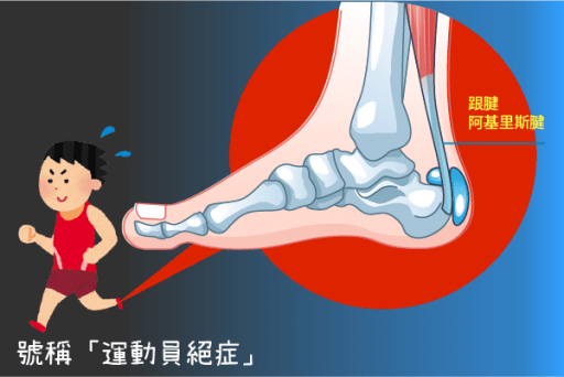 跟腱炎